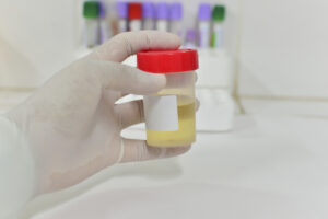 Gene Fusion Urine Testing Advances Early Prostate Cancer Diagnosis